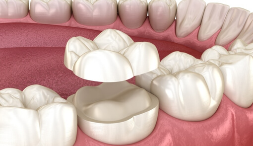 Ceramic Onlays/Inlays