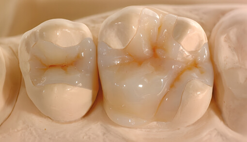 Composite Inlays (Select Cases)