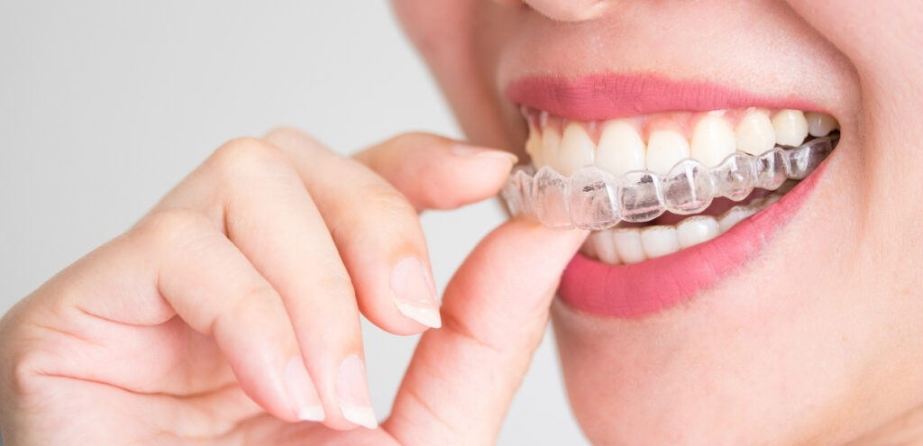 How Invisalign Works — Step by Step