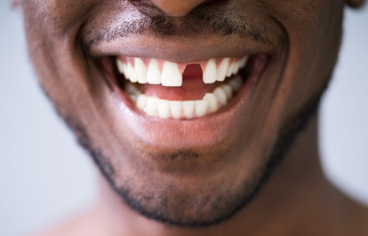 Knocked-Out Tooth Treatment