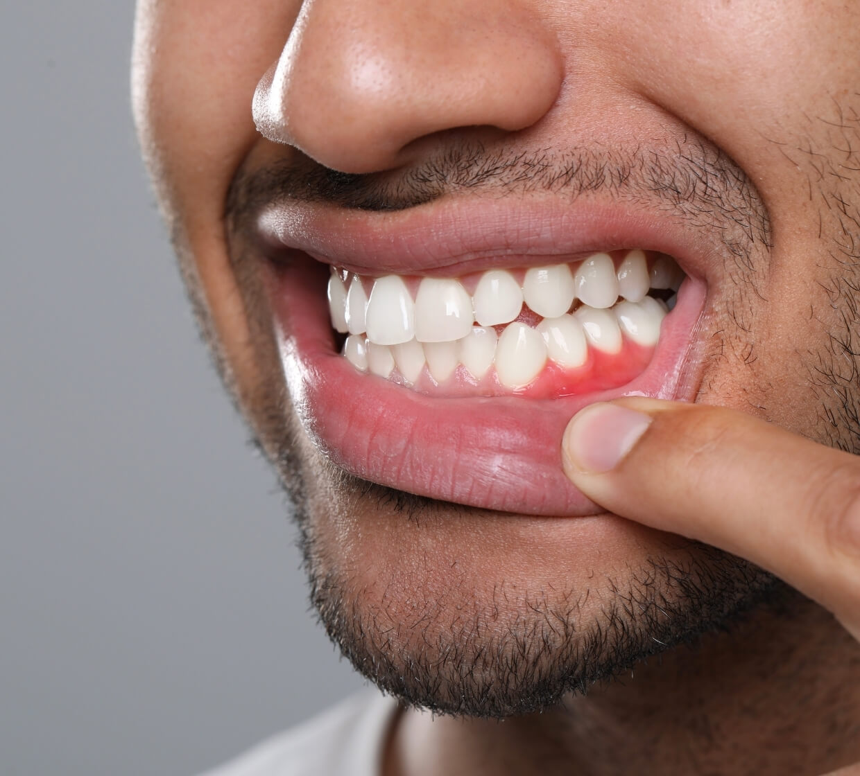 Signs You May Have a Dental Abscess