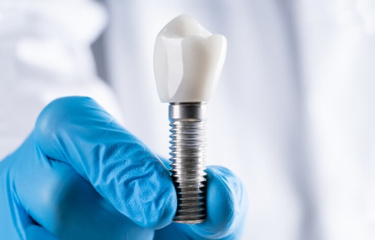 Single Tooth Dental Implants