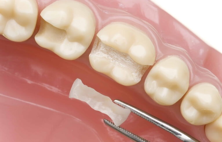 Tooth-Coloured Dental Fillings