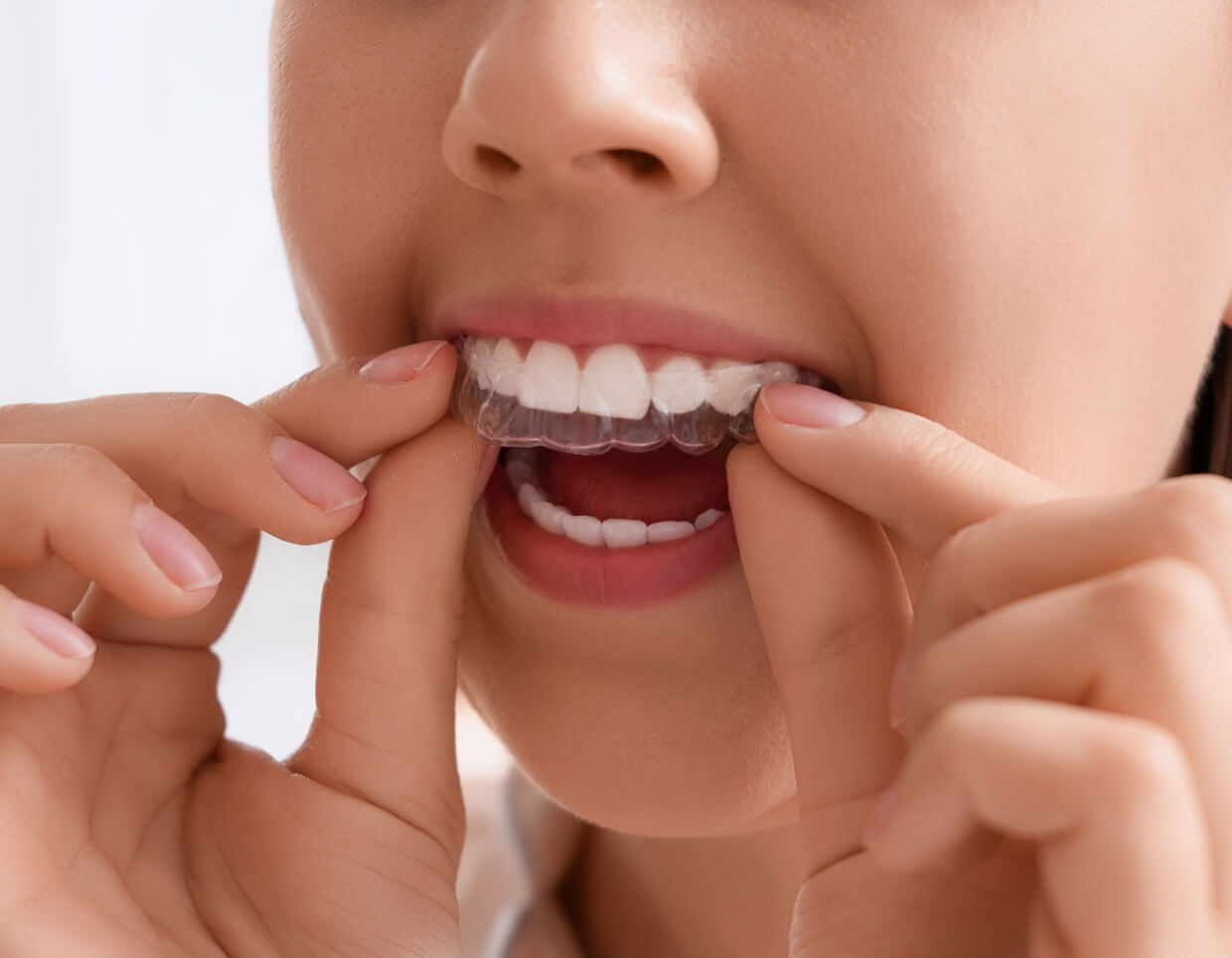 Types of Night Guards We Offer