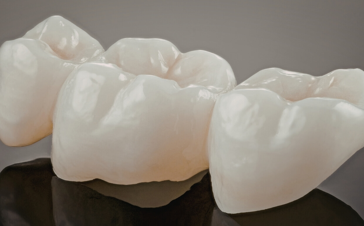 What Are Cosmetic Crowns?