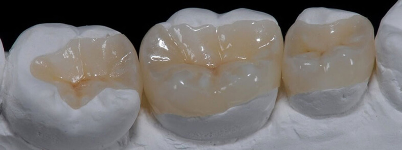 What Are Onlays and Inlays?