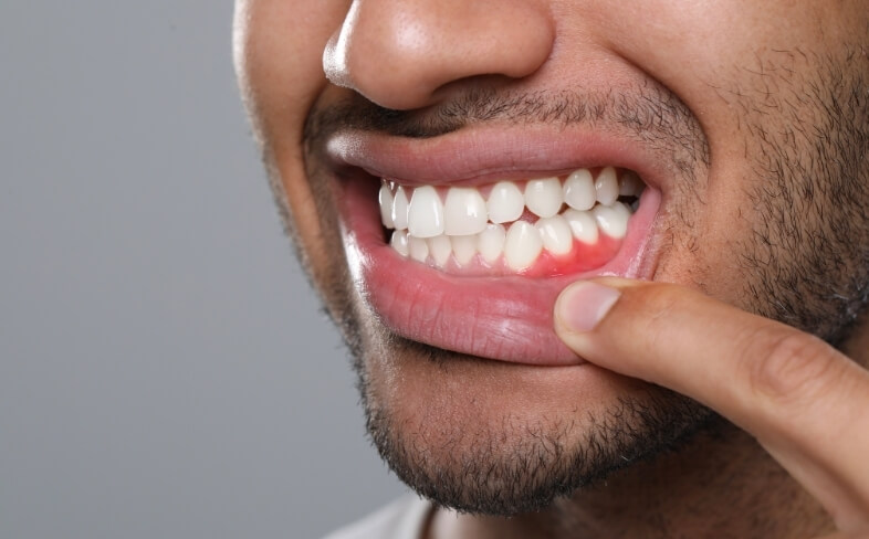 What Is Gum Disease