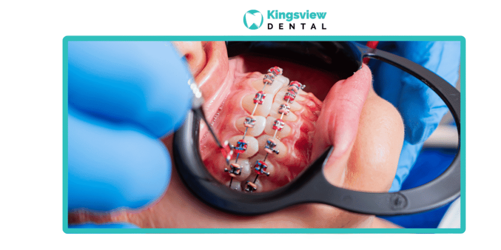 Invisalign Airdrie 1