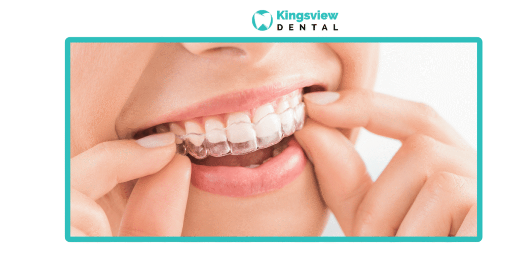 Invisalign Airdrie 6